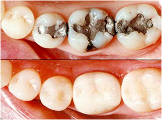 虫歯治療の際の詰めもの・被せものについて