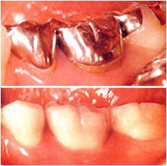 虫歯治療の際の詰めもの・被せものについて
