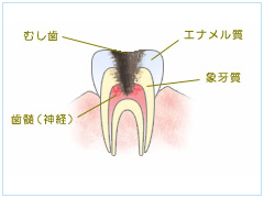 重度の虫歯になっても歯を残すための根管治療